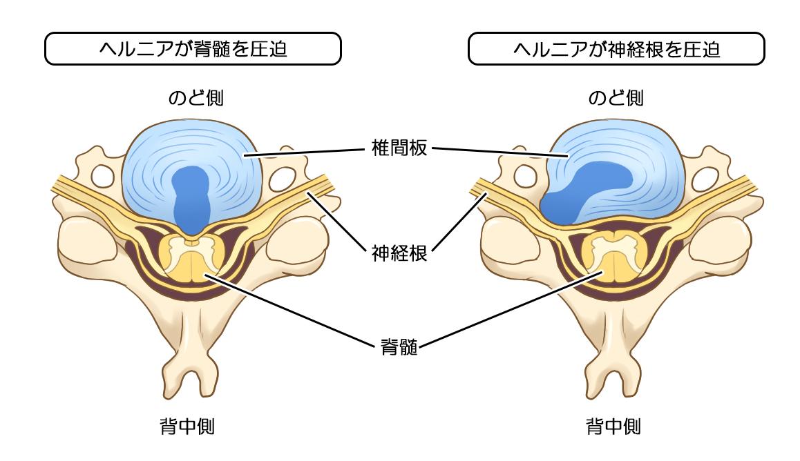 頚椎椎間板ヘルニア