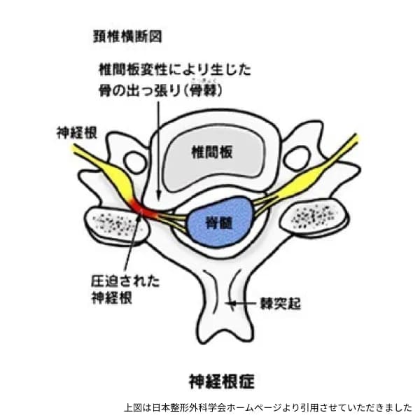 頚椎横断図